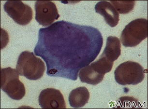 Mononucleosis - photomicrograph of cells