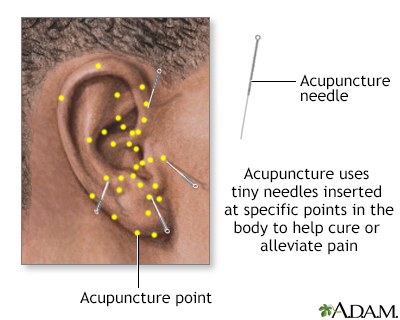 Acupuncture