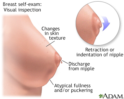 Breast self-exam