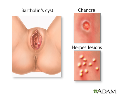 Genital sores (female)