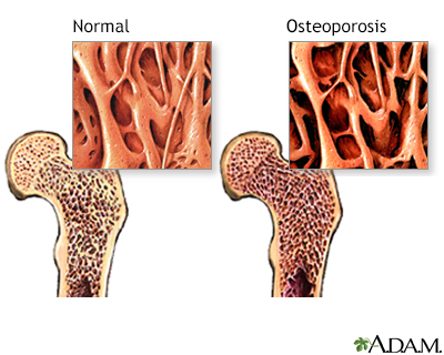 Osteoporosis