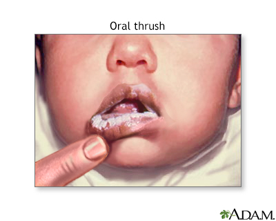 Oral thrush