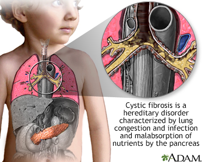 Cystic fibrosis