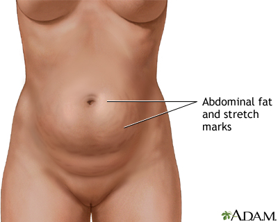 Abdominoplasty - series