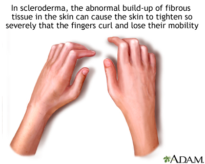 Sclerodactyly