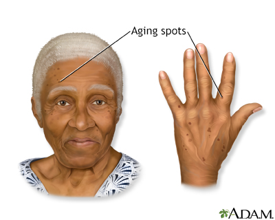 Aging spots