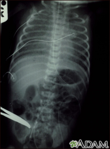 Totally anomalous pulmonary venous return - X-ray