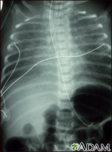 Totally anomalous pulmonary venous return - X-ray