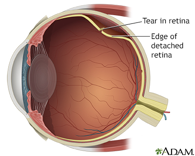 Detached retina