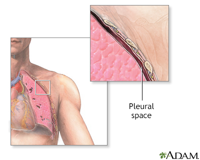 Chest tube insertion - series - Pleural cavity