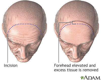 Procedure