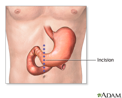 Gastrectomy incision