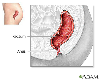 Rectal prolapse repair - series