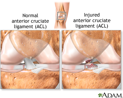 Anterior cruciate ligament (ACL) injury