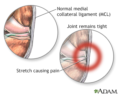 Medial collateral ligament pain