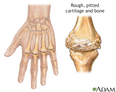 Rheumatoid arthritis