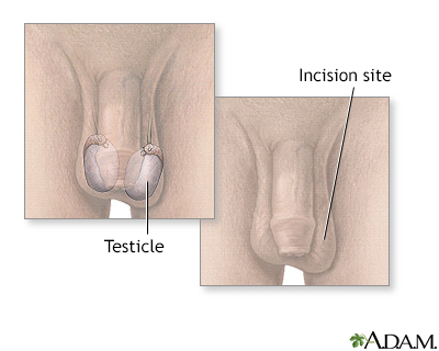 Testicular biopsy