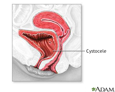 Cystocele