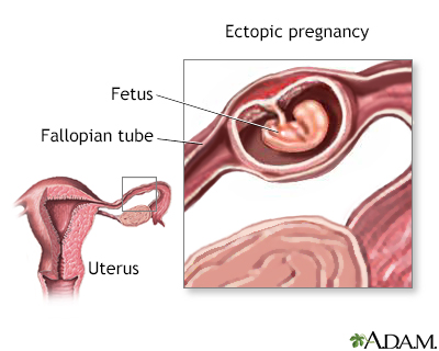 Ectopic pregnancy