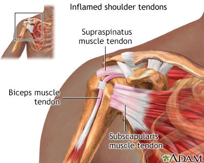 Inflamed shoulder tendons