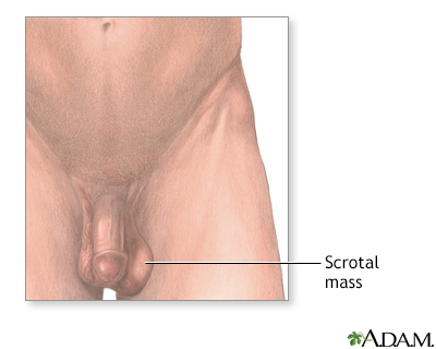 Scrotal mass