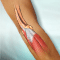 What is tennis elbow?
