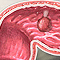 Colorectal polyps