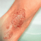 Psoriasis