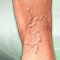 Varicose veins