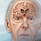 Alzheimer disease