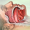 Obstructive sleep apnea