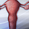 Hysterectomy