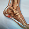 Plantar fasciitis