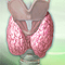 Hyperthyroidism