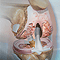 Osteoarthritis
