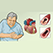 Angina causes and symptoms