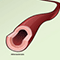 Atherosclerosis overview