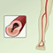 Peripheral artery disease (PAD) - overview