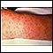 Rocky mountain spotted fever, lesions on arm