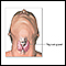 Thyroidectomy - Series