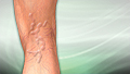 Varicose veins
