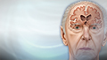Alzheimer disease