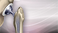 Hip joint replacement