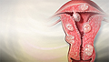 Uterine fibroids