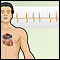 Cardiac arrhythmia symptoms