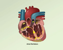 Atrial fibrillation overview
