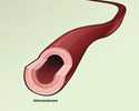 Atherosclerosis overview