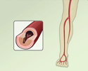 Peripheral artery disease (PAD) - overview
