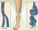 Varicose veins overview