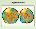 Heart disease modifiable risk factors - hyperlipidemia